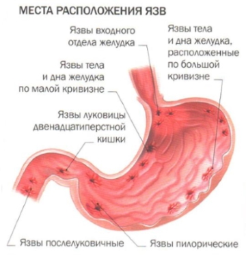 Язвенная болезнь желудка (Ulcus gastric): симптомы, причины, лечение - Медицинский портал