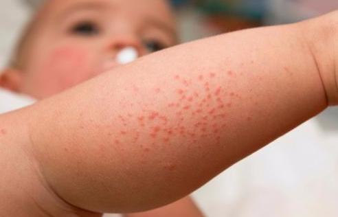 Аллергическая сыпь у детей - лечение в Зеленограде — медцентр АКСИС