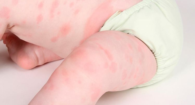 Аллергическая сыпь у ребенка